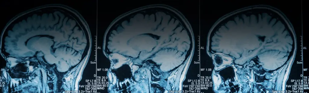 Brain Injury Attorney in Florida | Call 407-481-0066
